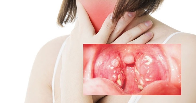 Có triệu chứng này đi khám ngay kẻo mắc bệnh Bạch hầu.