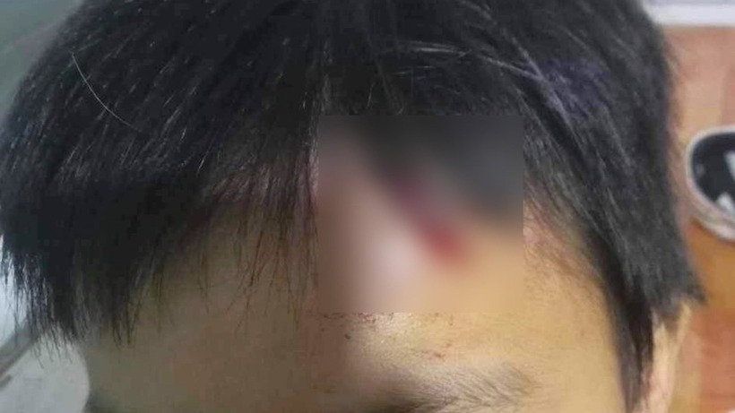 Vết thương trên trán cháu M.T. Ảnh: VOV