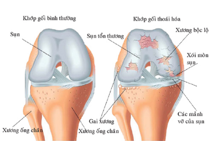Thoái hóa khớp là tình trạng các đầu xương bị bào mòn, va chạm với nhau gây viêm, sưng đau khớp