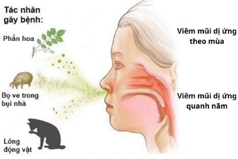 Viêm mũi dị ứng là tình trạng viêm vô khuẩn