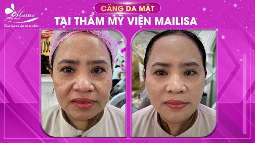 Khách hàng thực hiện căng da mặt bằng chỉ tại Thẩm mỹ viện Mailisa TPHCM