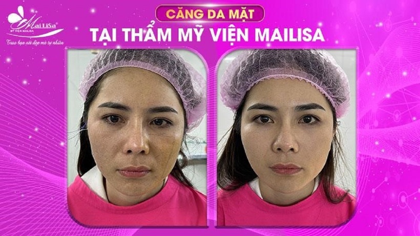 Dịch vụ căng da mặt siết cơ tại Mailisa TP HCM được khách hàng tin tưởng lựa chọn