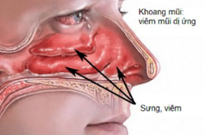 Viêm mũi dị ứng diễn biến nhanh và khả năng tái phát cao hơn viêm mũi thông thường