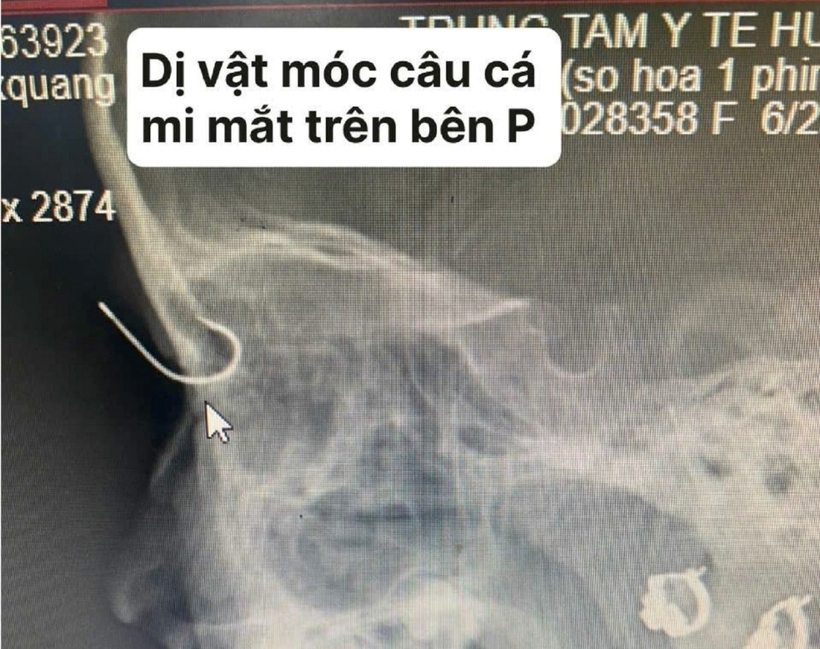 Hình ảnh móc câu xuyên qua mí mắt của bệnh nhi trên phim chụp. Ảnh: Gia Đình Việt Nam