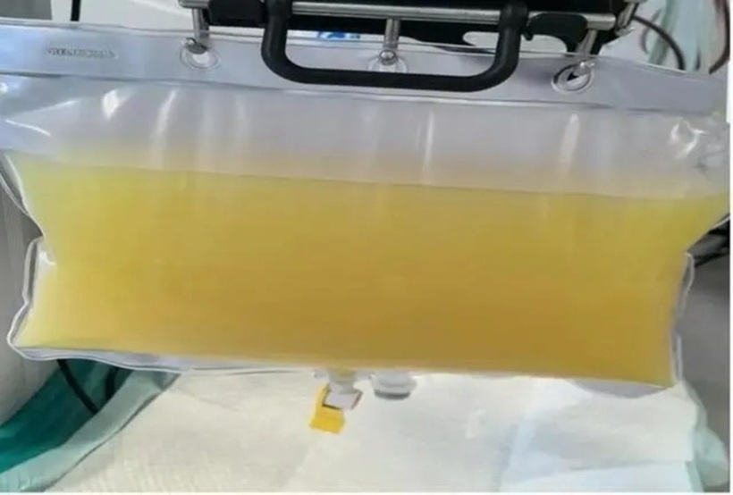 Rút ra 2 lít máu trắng như mỡ lợn từ người đàn ông nhập viện vì đau bụng. Ảnh minh họa