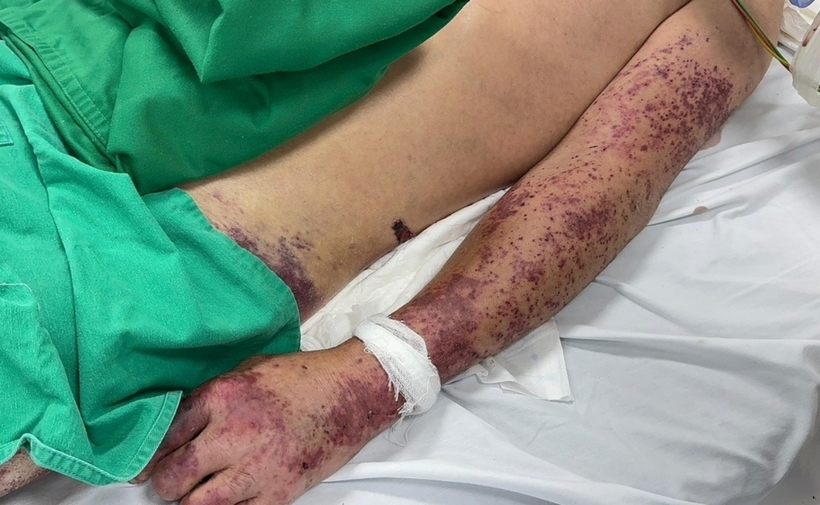 Hình ảnh ban xuất huyết nổi dày đặc trên da của bệnh nhân nhiễm khuẩn liên cầu lợn. Ảnh: Tri Thức