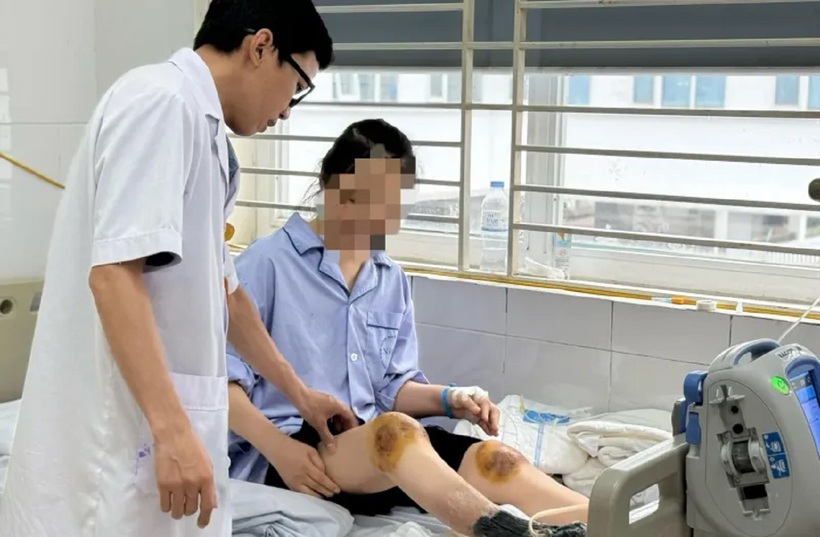 Người bệnh đang được điều trị tại Bệnh viện Bệnh Nhiệt đới Trung ương. Ảnh: BVCC