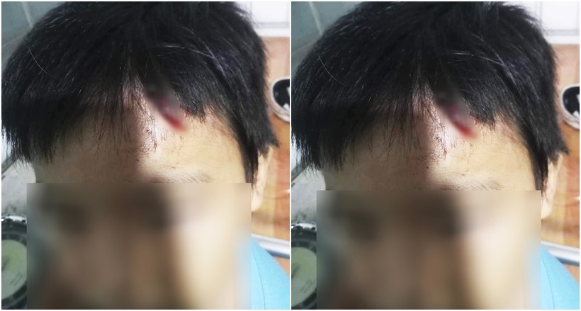 Vết thương bé T. bị bà N. hành hạ. (Ảnh: Tuổi trẻ)