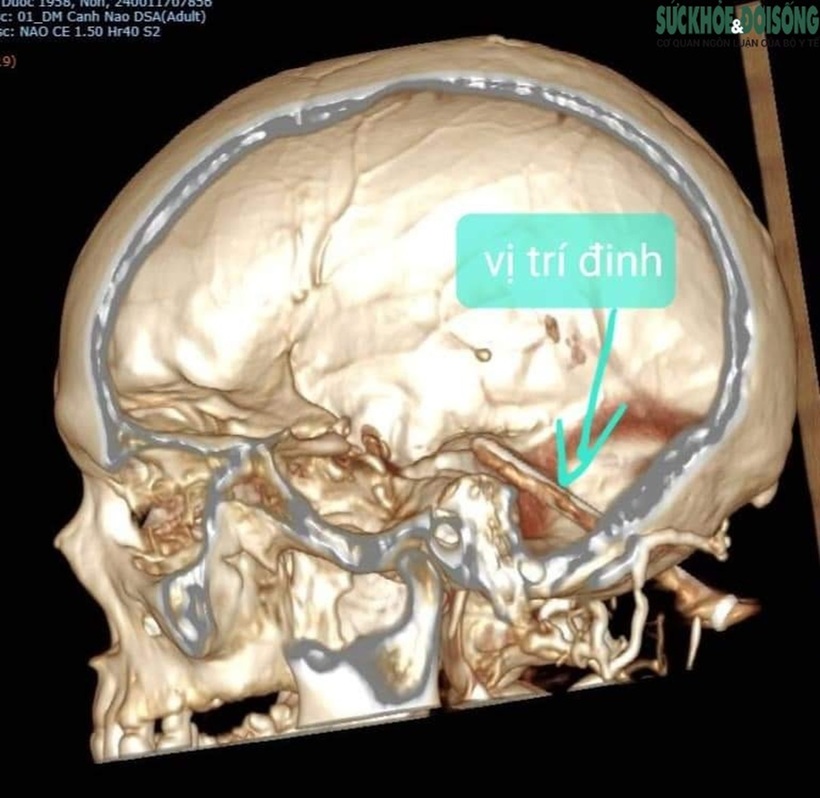 Dị vật là chiếc đinh dài xuyên sọ nằm sâu trong não khoảng 1 năm. Ảnh: Sức khỏe & Đời sống