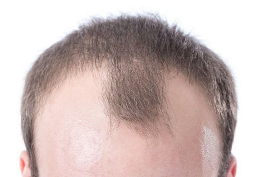 Hói đầu nhiều khả năng là do yếu tố di truyền. Ảnh minh họa