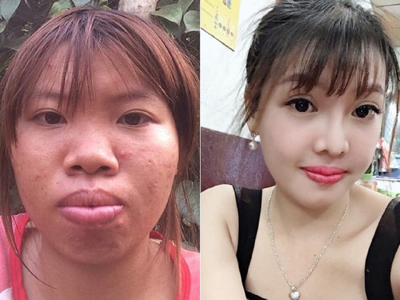 Quách Thị Kim Phượng từng là "hiện tượng mạng" khi dũng cảm đăng tải hành trình phẫu thuật thẩm mỹ và lột xác đầy ngoạn mục.