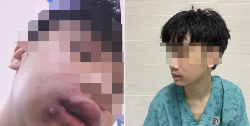 Nam thanh niên sưng nề một bên mặt, không há được miệng ở thời điểm vào viện (bên trái), sau vài ngày điều trị thì tình trạng sức khỏe ổn định, được ra viện. Ảnh: VietNamNet