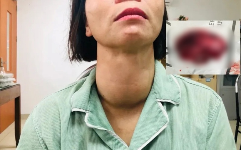 Người phụ nữ có khối u vùng cổ hơn 10 năm nay, chưa điều trị. Ảnh: VTV Times