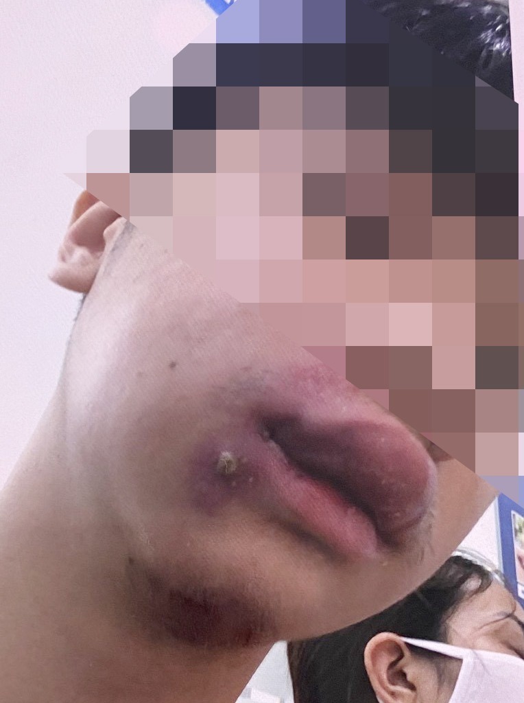 Bệnh nhân có mụn ở mép môi dưới bên má trái, kèm theo sưng nề, nóng đỏ. Ảnh: BVCC.