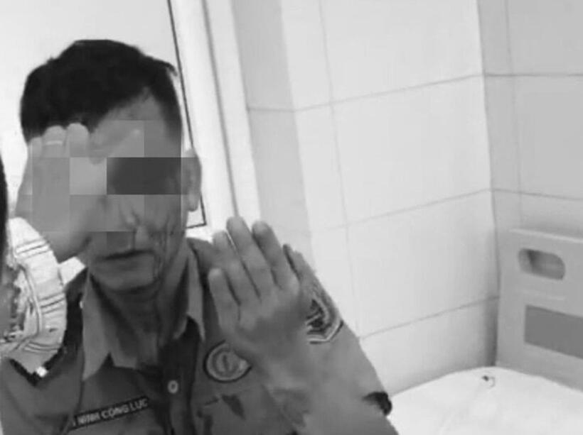 Nhân viên bảo vệ Bệnh viện K bị hành hung, đấm vào đầu và mặt, phải khâu 8 mũi. Ảnh:VTC News