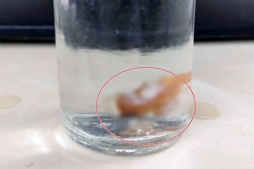 Chiếc răng giả mắc kẹt trong phổi nam bệnh nhân khi được lấy ra ngoài. Ảnh: Dân Trí