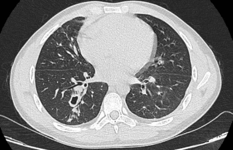 Hình ảnh phim chụp cắt lớp phổi của bệnh nhân nhiễm sán lá phổi. Ảnh: VTC News