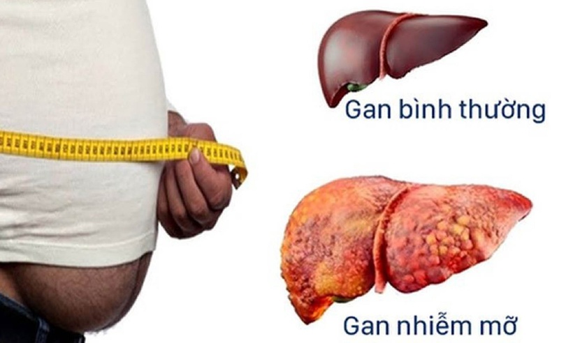 Gan nhiễm mỡ là hiện tượng mỡ hoặc chất béo tích tụ trong các tế bào gan. Ảnh minh họa