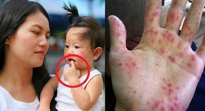 Bệnh tay chân miệng dễ dàng lây nhiễm qua tiếp xúc trực tiếp