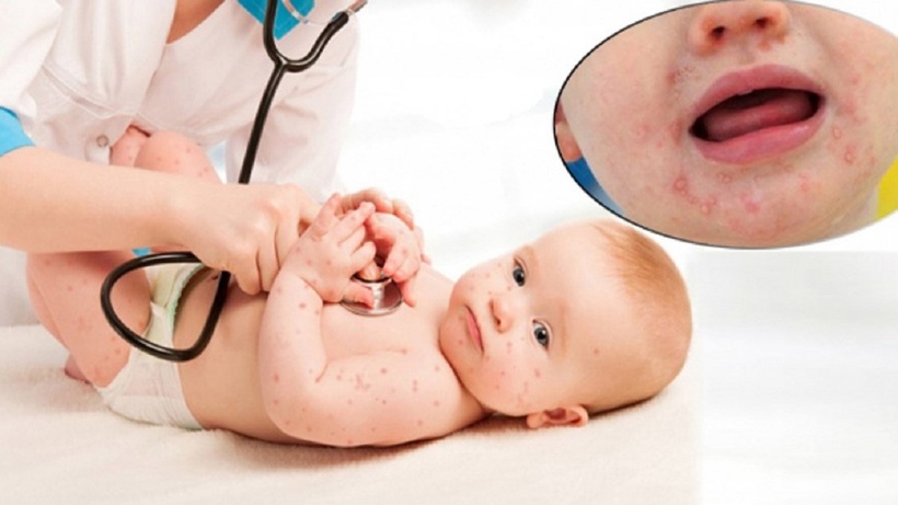 Trẻ bị tay chân miệng có thể tiềm ẩn một số biến chứng nguy hiểm