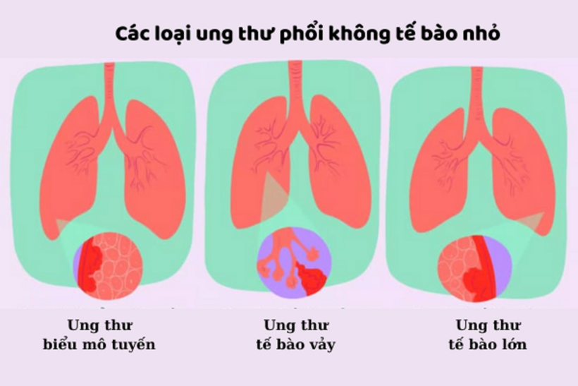 3 loại ung thư phổi không tế bào nhỏ
