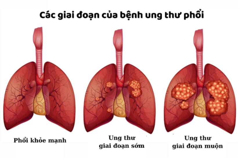 Mô tả giải phẫu phổi trong các giai đoạn ung thư