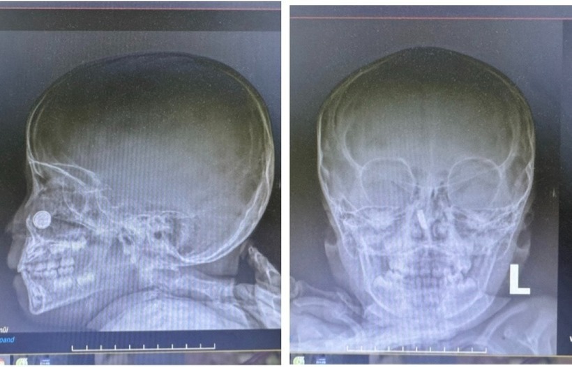 Hình chụp X-quang của bệnh nhi. Ảnh: BVCC.