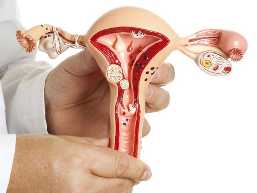 Nhân xơ tử cung là bệnh lý phổ biến ở phụ nữ độ tuổi sinh sản