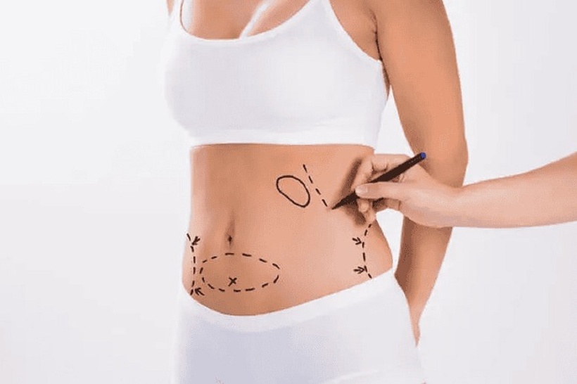 Hút mỡ có thể gây sốc thuốc, sốc phản vệ, ngộ độc, huyết tắc mỡ... thậm chí tử vong nếu không được xử lý kịp thời. Ảnh minh họa