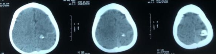 Hình chụp CTScan ghi nhận vết thương xuyên vào trong nhu mô não. Ảnh: BVCC.