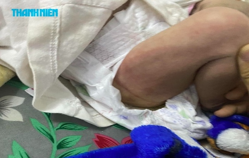 Sau trận bạo hành, đùi em bé (1 tháng tuổi) sưng đỏ, in rõ dấu bàn tay.