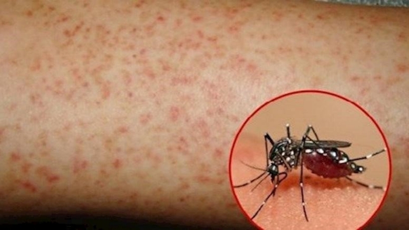 Cộng dồn năm 2024, Hà Nội ghi nhận 2.737 ca mắc sốt xuất huyết, không có ca tử vong. Ảnh minh họa