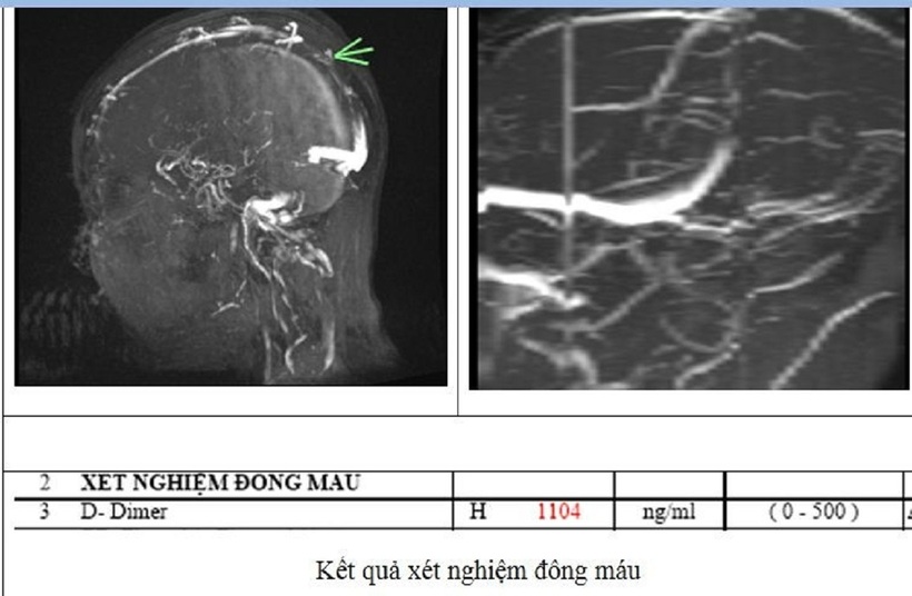 Kết quả xét nghiệm đông máu của bệnh nhân. Ảnh: Bệnh viện Đa khoa tỉnh Phú Thọ
