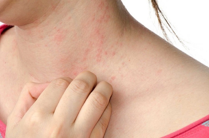 Nhiều người bị dị ứng khi ăn cua