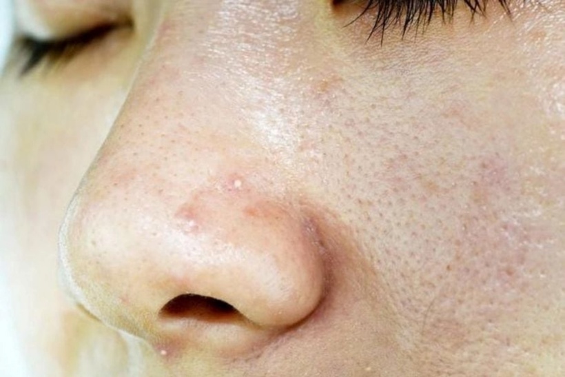 Nếu không được làm sạch kỹ lưỡng, có thể gây ra mụn.