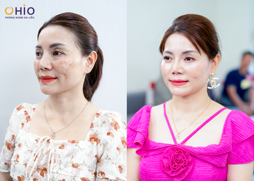Khách hàng đã điều trị nám thành công