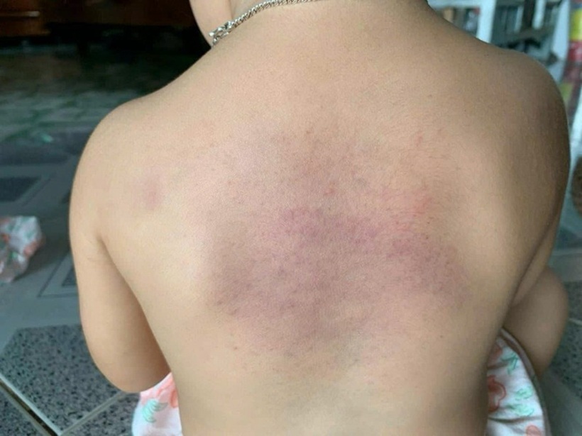 Những vết thâm trên cơ thể trẻ. Ảnh: Công an Nhân dân