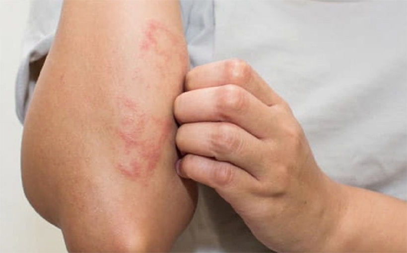 Nhiều bệnh nhân chàm, vảy nến còn kèm theo nhiều biến chứng khác như: khớp, tiểu đường