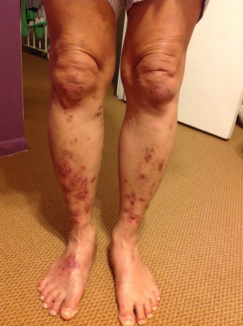 Bảo Thanh Đường có thuốc chữa trị dứt điểm bệnh chàm