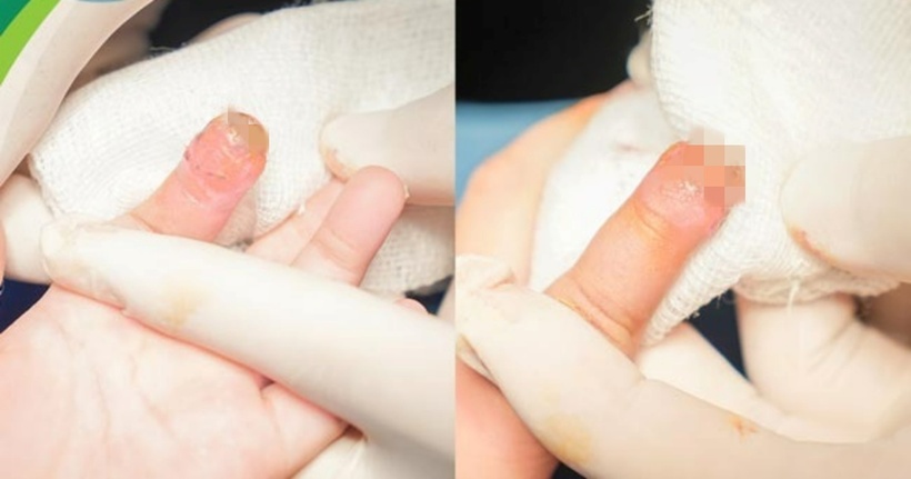 Sau hơn 10 ngày điều trị, vết thương khô, đầu ngón tay trẻ hồng ấm, sức khỏe tiến triển tốt nên đã được xuất viện. Ảnh: BVCC.