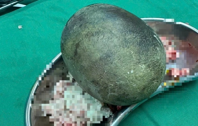 Cận cảnh viên sỏi bàng quang to như quả bóng, nặng gần 1kg bác sĩ lấy từ trong cơ thể bệnh nhân. Ảnh: PLO
