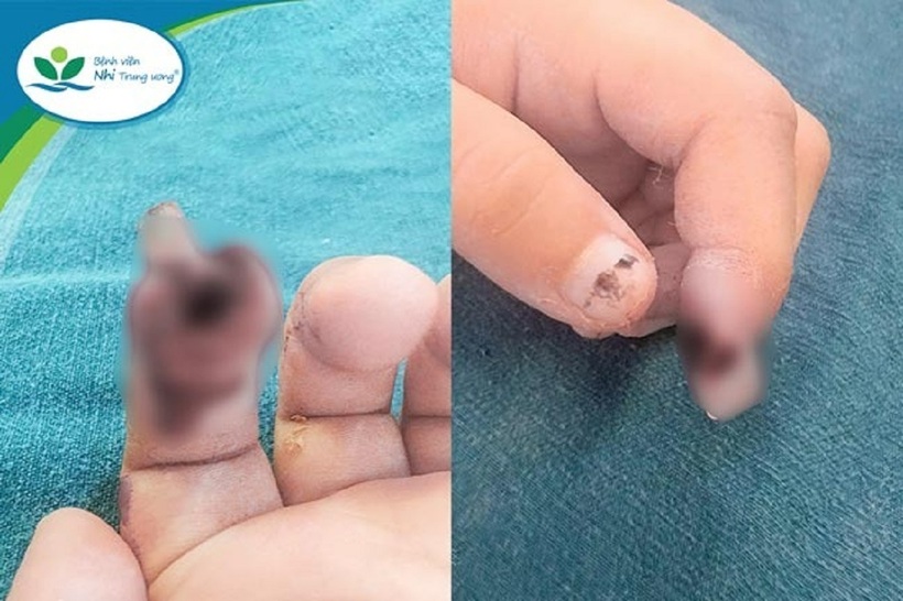 Kẹt tay vào cửa, bé gái ở Hà Nội nhập viện với búp ngón tay bị đứt. Ảnh: Bệnh viện Nhi Trung ương