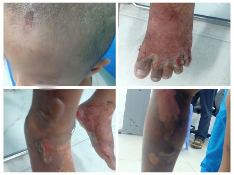 Những vết thương trên người bé trai 6 tuổi nghi bị bạo hành, cơ thể bỏng rộp. Ảnh: Lao động