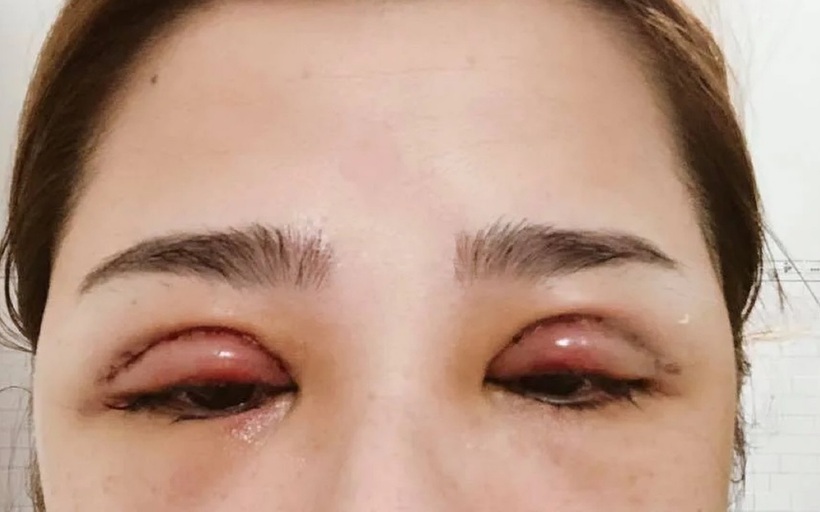 Một ca nhấn mí bị sưng tấy, biến chứng. Ảnh minh họa