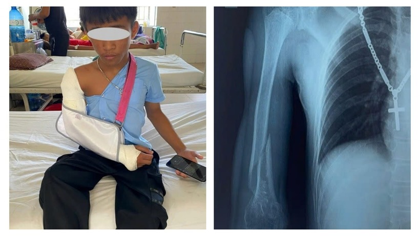 Nam sinh 13 tuổi bất ngờ nhập viện cấp cứu sau trò chơi quen thuộc. Ảnh: Bệnh viện Đa khoa Khánh Hòa.