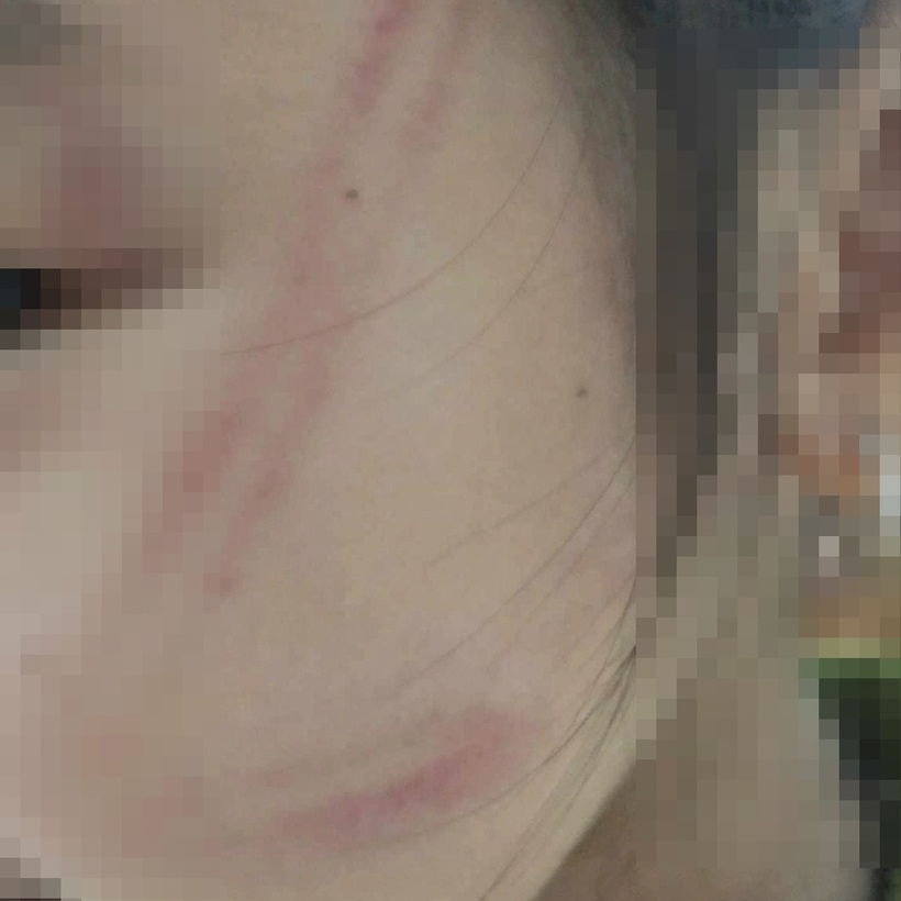 Trên mặt một trẻ hằn vết bầm. Ảnh: Dân trí