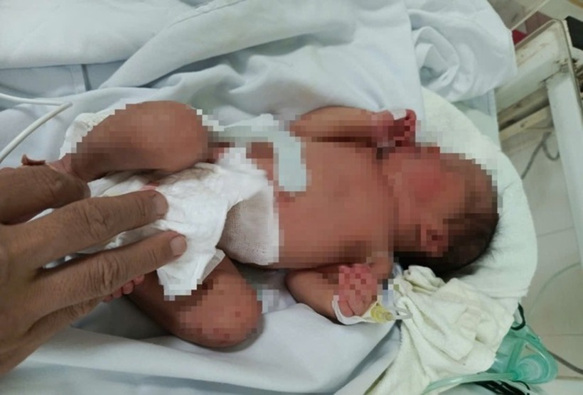 Trẻ sơ sinh bị bỏ rơi bên đường đã được các y, bác sĩ Bệnh viện Nhi Thanh Hóa cứu sống. Ảnh: Người Lao Động