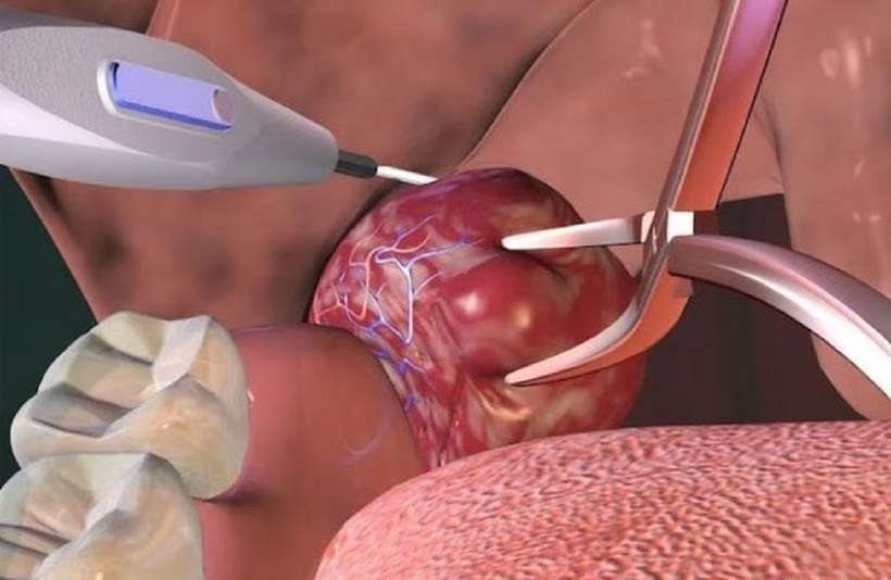 Chỉ định cắt amidan trong trường hợp cần thiết