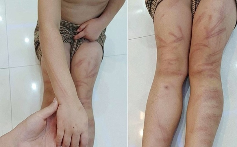Vết bầm tím trên người trẻ mầm non. Ảnh: Lao động
