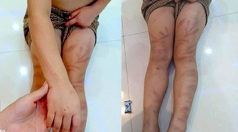 Bé mầm non bị đánh bầm tím người. Ảnh: Tiền Phong